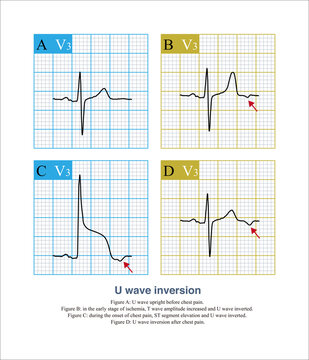 Male, 59 years old, clinically diagnosed as variant angina pectoris. The U wave of the patient was upright before the onset of angina pectoris, and inverted during and after the onset of chest pain.