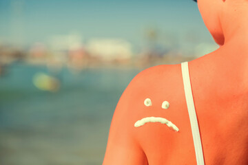 Fototapeta premium Woman with sun protection cream in the shape of sad smile on her burned shoulder. Summer, healthcare and vacation concept