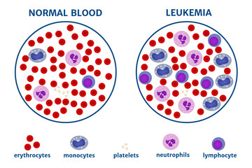 Leukemia. blood cancer. bodies under the microscope. Medical poster. Vector illustration