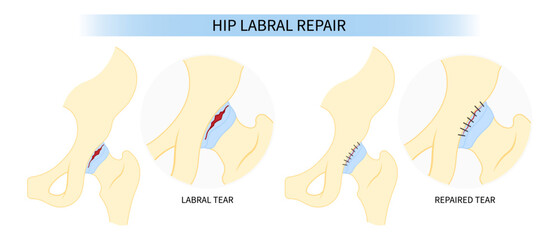 Surgery for hip bone Pain and range of motion groin head tear Treat joint thigh femur injury spurs socket lesion - obrazy, fototapety, plakaty
