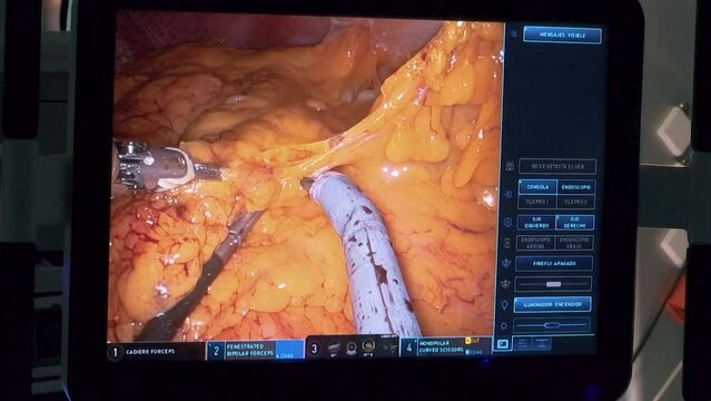 MONITORING ARMS FROM SURGERY MACHINE OPERATING ADIPOSE TISSUE WITHIN HUMAN BODY