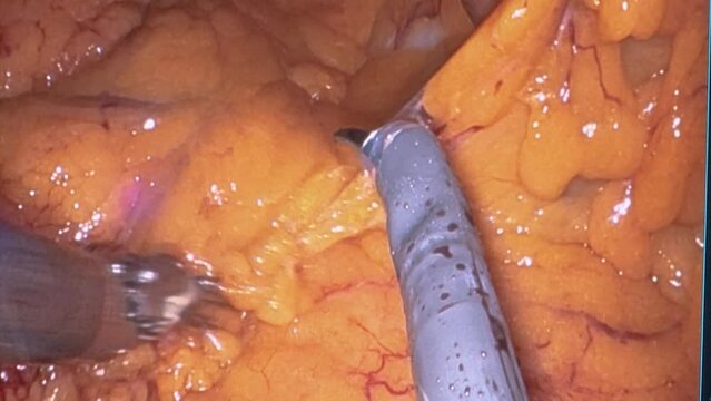 MONITORING ARMS FROM SURGERY MACHINE OPERATING ADIPOSE TISSUE WITHIN HUMAN BODY