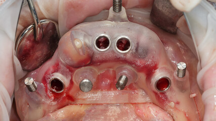 Fototapeta premium surgical dental template in the oral cavity before total implantation