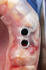 Fototapeta premium gum cavity with template for implantation of two teeth