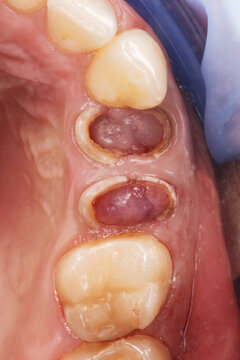 gum cavity without two teeth for implantation
