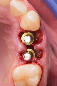two dental abutments after implantation