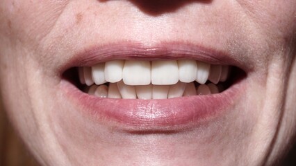 Teeth after caries treatment. Woman with veneers smiling at camera