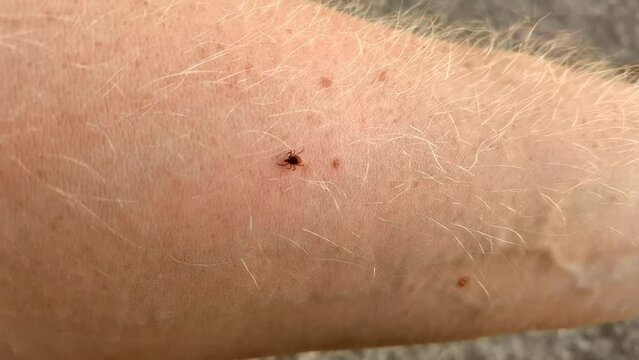 A tick crawls over a person's hand. Many hard ticks are of considerable medical importance, acting as vectors of diseases caused by bacteria, protozoa, and viruses, such as Rickettsia and Borrelia.