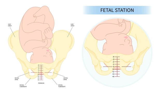 Labor and C section fetal Baby born Head Down by praevia Mother twins cord hip lie bone canal Left womb Right spine pelvis cervix score birth Breech defect vertex Exam uterus Frank Bishop weeks Infant