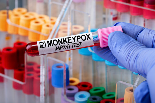 Researcher holding blood test tube infected with monkey pox Monkeypox virus (MPXV). Doctor with a blood test in a tube diagnosed positive with zoonotic virus MPXV Monkeypox disease.