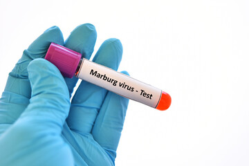 Fototapeta premium Test tube with blood sample for Marburg virus test, new epidemic disease in Africa