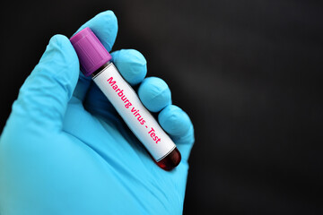 Obraz premium Test tube with blood sample for Marburg virus test, new epidemic disease in Africa