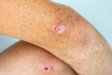 Fototapeta premium A small wound on the elbows and knees of a teenager