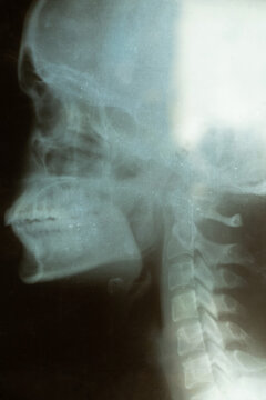 Old x-ray of woman's skull closeup,skull examination,diagnosis