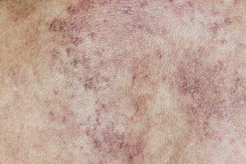 Fototapeta premium Texture red rash on back man