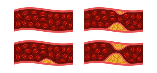 Atherosclerosis. Cholesterol in Blood Vessels Set. Vector