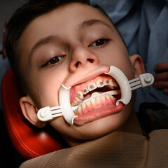 White retractor on lips and installation of metal braces on teen's upper teeth.