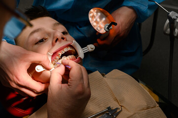 The teenager has braces glued to his upper teeth to straighten them, and the boy has a retractor on his lips.