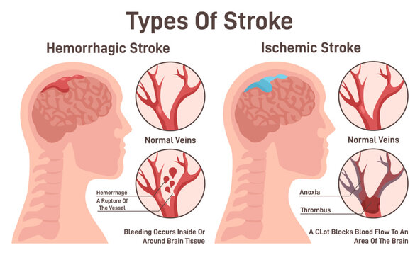 Stroke types set. Hemorrhagic and ischemic brain stroke. Damaged human