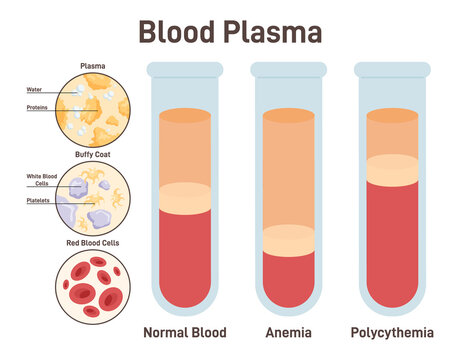 Blood plasma. Structure of normal blood, blood with anemia