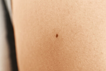 Fototapeta premium Closeup view of woman's body with birthmark