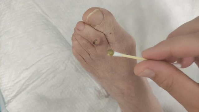 The doctor treats a purulent wound on the leg of an elderly patient with a healing ointment