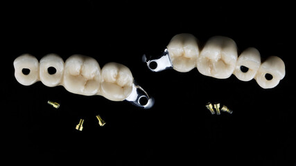two dental prosthesis bridges made of zircon and titanium on a black background