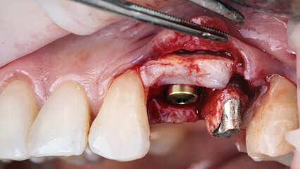 surgical dental photo of shaper and soft tissue flap for gingiva