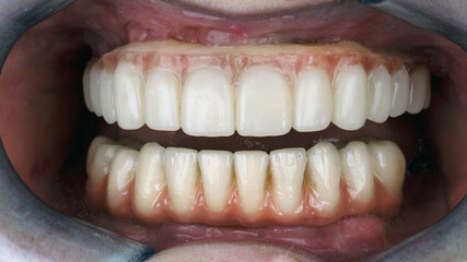 temporary dental prosthesis of the upper jaw made of polymer and permanent prosthesis of the lower jaw © Dental Pro Content