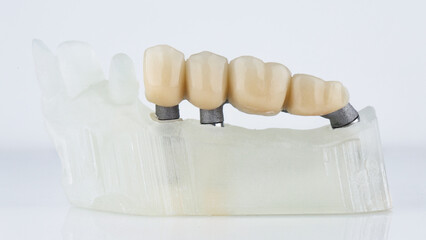dental model with a bridge prosthesis on a metal beam on a white background