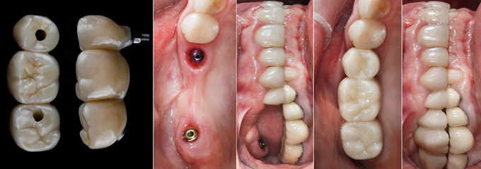 dental collage of zircon bridge, gum cavity and installed bridge