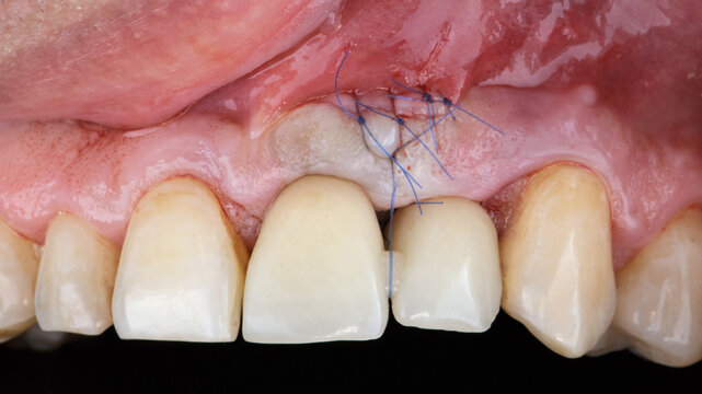 two sutured dental crowns with fixation on the gum