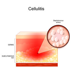 cellulitis. Cross section of layers of the human Skin with symptoms of Infectious disease. Close-up of Staphylococcus aureus. bacterial infection. Bacteria involving the inner layers of the skin.