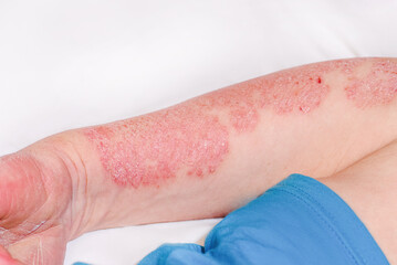 Acute psoriasis on the arm of a man, severe redness on the skin, an autoimmune incurable...