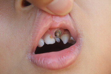 teeth in children cleft lip or cleft palate that is damaged, cavities and stony