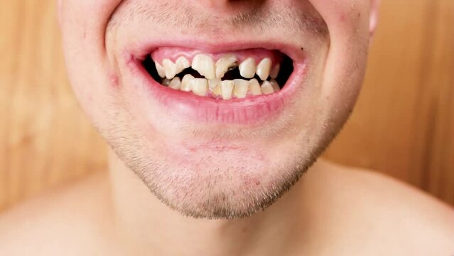Broken teeth in a young man. The guy demonstrates broken, chipped teeth in the oral cavity. Dental concept.Tooth trauma.