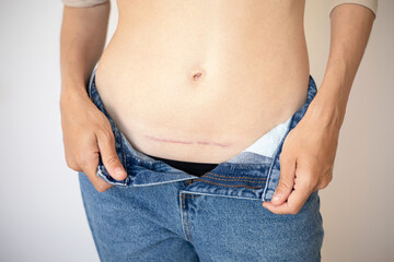 Naklejka premium Close up Mom's abdomen after cesarean section. Scar seam. bodypositive diversity Real motherhood. Lifestyle