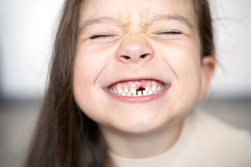 Close-up A cute funny girl without a baby tooth. A toothless smile. A milk tooth fell out....