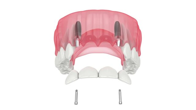 Upper jaw with dental bridge supported by implants 