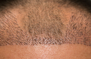 Close up top view of a man's head with hair transplant surgery with a receding hair line.