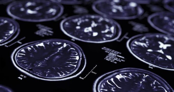 Slider shot of MRI brain scan
