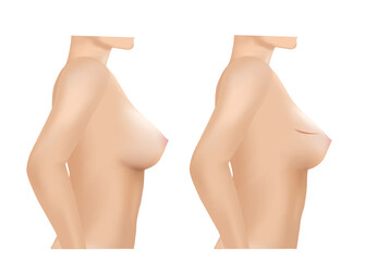Breast cancer surgery scars, lumpectomy, Breast cancer removal - obrazy, fototapety, plakaty