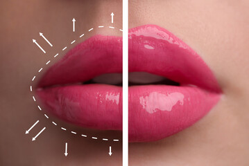 Collage with photos of young woman before and after lips augmentation procedure, closeup