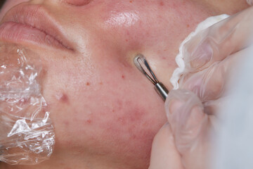 Mechanical facial cleansing, skin cleansing procedure from surface and deep impurities. new.