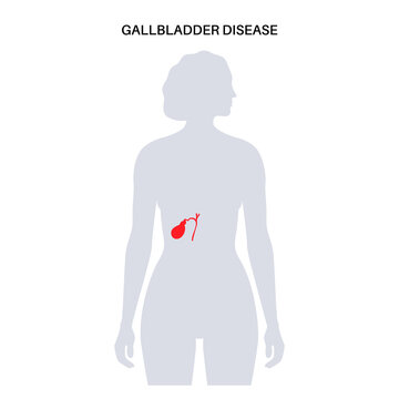 gallbladder disease poster