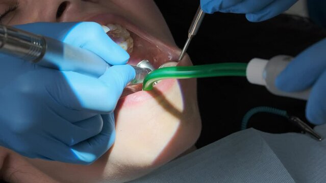 Extreme closeup shot of dental procedure on a caucasian female patient with dental turbine handpiece, mirror and saliva ejector in mouth