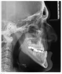x-ray image from a man before an orthognathic surgery and pieces to metal used to hold the bones...