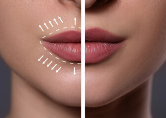 Collage with photos of young woman before and after lips augmentation procedure, closeup