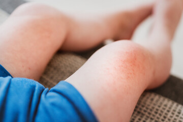 food allergies, eczema, or diathesis in a small child on the legs