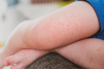 food allergies, eczema, or diathesis in a small child on the legs